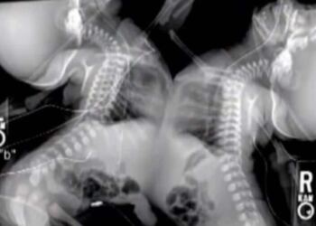 Έγκυος έκανε υπερηχογράφημα – Όταν το είδαν οι γιατροί πάγωσαν και της είπαν