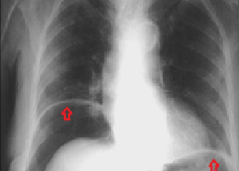Πονούσε στην κοιλιά, πήγε στο νοσοκομείο και οι γιατροί ανακάλυψαν μέσα του