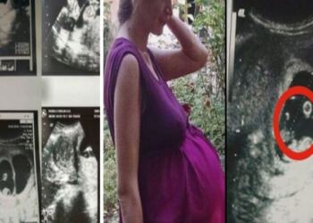 Όταν οι γιατροί είδαν το υπερηχογράφημα 36χρονης εγκύου φοβήθηκαν να την αγγίξουν – Δεν είχαν αντιμετωπίσει ποτέ κάτι παρόμοιο