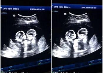 Έγκυος πήγε για υπερηχογράφημα – Μόλις κοίταξε την οθόνη πάγωσε