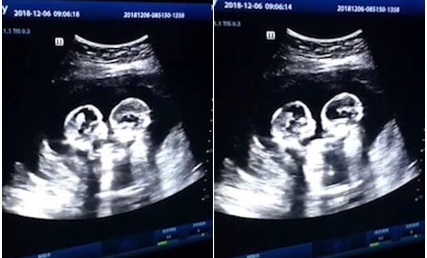 Έγκυος πήγε για υπερηχογράφημα – Μόλις κοίταξε την οθόνη πάγωσε