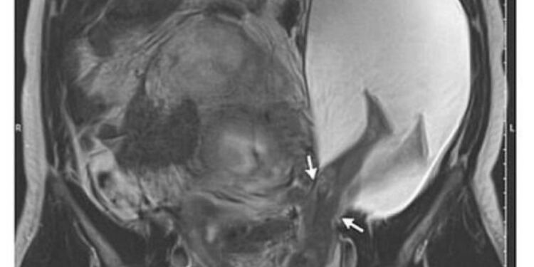 27χρονη έγκυος ήταν έτοιμη να γεννήσει – Όμως αυτό που έκανε το μωρό παραλίγο να της στοιχίσει τη ζωή