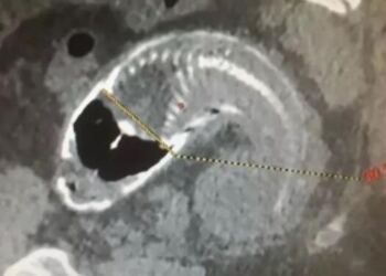 30χρονος είχε αφόρητους πόνους στο στομάχι – Αυτό που βρήκαν στο έντερό του σόκαρε τους γιατρούς