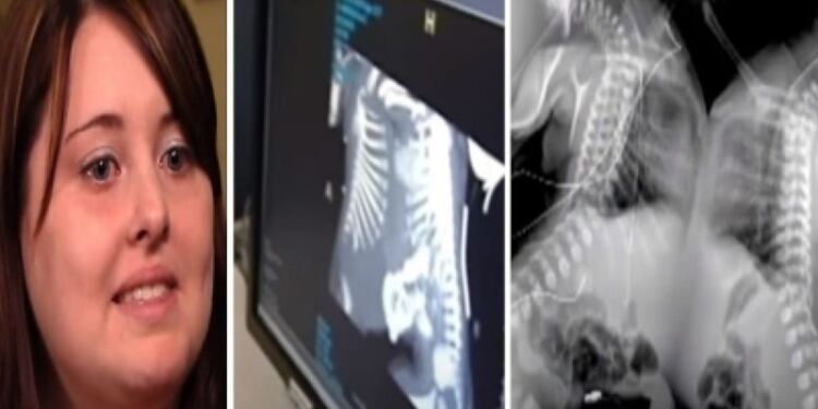 27χρονη έγκυος πήγε να κάνει υπερηχογράφημα – Όταν το είδαν οι γιατροί πάγωσαν και της είπαν..