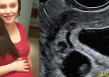 31χρονη έμεινε έγκυος σε δίδυμα – Αλλά το ένα δεν είναι δικό της παιδί! (Video)
