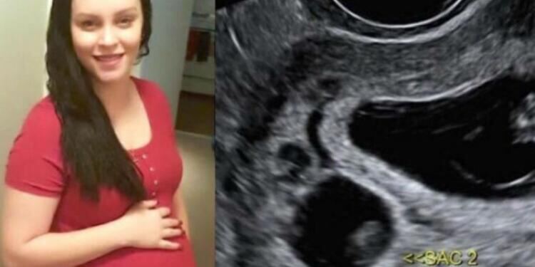 31χρονη έμεινε έγκυος σε δίδυμα – Αλλά το ένα δεν είναι δικό της παιδί! (Video)