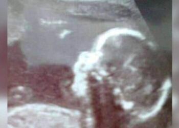 Έγκυος είδε στον υπέρηχο την μύτη του μωρού της και την κατέβαλε ο τρόμος…Δεν πίστευε αυτό που αντίκρισε στην γέννα!