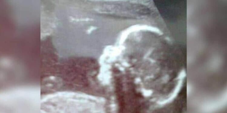 Έγκυος είδε στον υπέρηχο την μύτη του μωρού της και την κατέβαλε ο τρόμος…Δεν πίστευε αυτό που αντίκρισε στην γέννα!