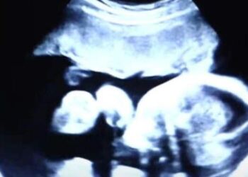 52χρονη είναι έγκυος στα δίδυμα παιδιά του γαμπρού της – Όταν όμως οι γιατροί είδαν τον τελευταίο υπέρηχο «πάγωσαν»