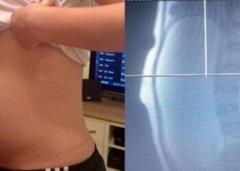 Νόμιζαν ότι αυτή η 17χρονη έφηβη ήταν έγκυος… Όταν όμως οι γιατροί είδαν την αξονική της «πάγωσαν»