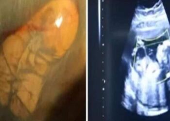 31χρονη ήταν 40 εβδομάδων έγκυος αλλά δεν πήγε ποτέ στον γιατρό για εξετάσεις – Αυτό που έδειξε ο πρώτος υπέρηχος…