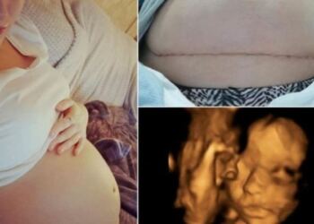 26χρονη μητέρα γέννησε πρόωρα μωρό – Αυτό που έκαναν μετά οι γιατροί θα σας αφήσει άφωνους