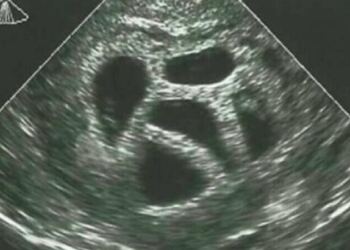 Μια έγκυος γυναίκα αγνόησε τις συμβουλές του γιατρού να κάνει έκτρωση… 20 χρόνια αργότερα δημοσιεύει αυτό!