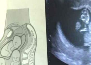 Αυτή η γυναίκα ήταν έγκυος σε τρίδυμα αλλά αυτό που είδαν στον υπέρηχο…Πάγωσε ακόμα και τους γιατρούς!