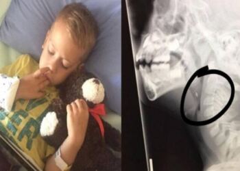 6χρονο αγοράκι έφαγε ένα κοτόπουλο και άρχισε να έχει πόνους στο λαιμό – “Πάγωσαν” όταν είδαν τα αποφάγια