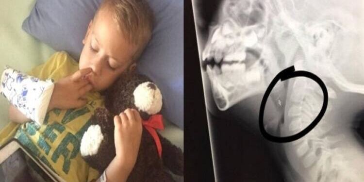 6χρονο αγοράκι έφαγε ένα κοτόπουλο και άρχισε να έχει πόνους στο λαιμό – “Πάγωσαν” όταν είδαν τα αποφάγια