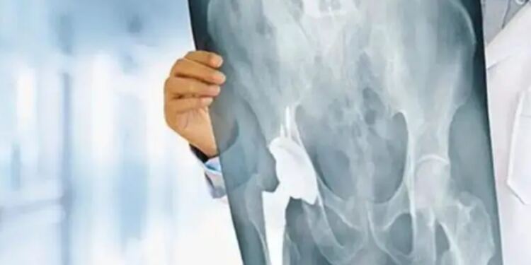 Άφωνοι οι Γιατροί στο νοσοκομείο Μυτιλήνης με 99χρονη μετά από εγχείρηση για κάταγμα ισχύου – Δείτε τι συνέβη