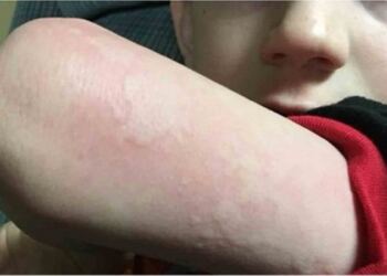 9χρονος Επιστρέφει από το Σχολείο, Γεμάτος Κόκκινα Σημάδια. Οταν το πήγαν για εξετάσεις έμαθαν την αλήθεια.