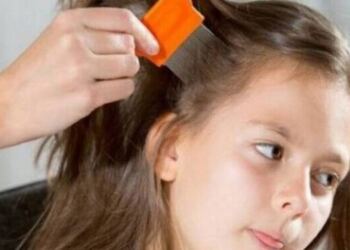 Τραγωδία σοκ-Πάγωσαν με το θέαμα οι αστυνομικοί: Νεκρή 12χρονη από ψείρες στο κεφάλι, της ήπιαν όλο το αίμα-Συνελήφθησαν οι γονείς