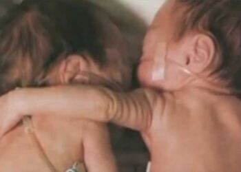 Έβαλε το χεράκι της γύρω από την αδερφούλα της που πέθαινε… Αυτό που συνέβη μετά όμως δεν το περιμέναμε!