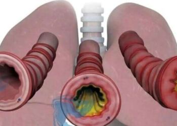 Πώς να απαλλαγείτε από τα φλέγματα και τη βλέννα στον λαιμό