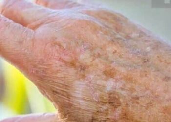 Γιατί εμφανίζονται κηλίδες στα χέρια μας και πώς μπορούμε να τις εξαλείψουμε;