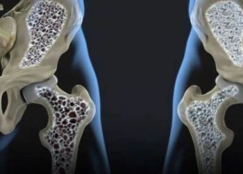 Οι κρυφοί ένοχοι πίσω από την οστεοπόρωση: 3 δημοφιλή ποτά που πρέπει να προσέξετε