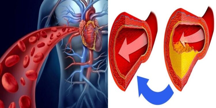 Πώς θα καταλάβετε αν φράζουν οι αρτηρίες σας; Δείτε 4 (τέσσερα) βασικά σημάδια