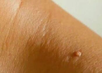 Γιατί εμφανίζονται σαρκώδεις ελιές στο λαιμό ή στις μασχάλες μου και πώς μπορώ να τις αφαιρέσω; Οι ειδικοί εξηγούν