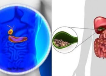 Οι τροφές που «σπάνε» τις πέτρες στη χολή με φυσικό τρόπο