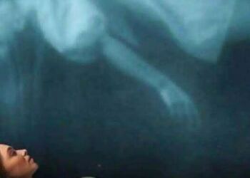 Οι ειδικοί ρίχνουν φως στο φαινόμενο του «επιθανάτιου ρόγχου» πριν τον θάνατο